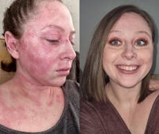 Escocia: una mujer erradicó una grave y duradera dermatitis atópica gracias a una crema facial de £9