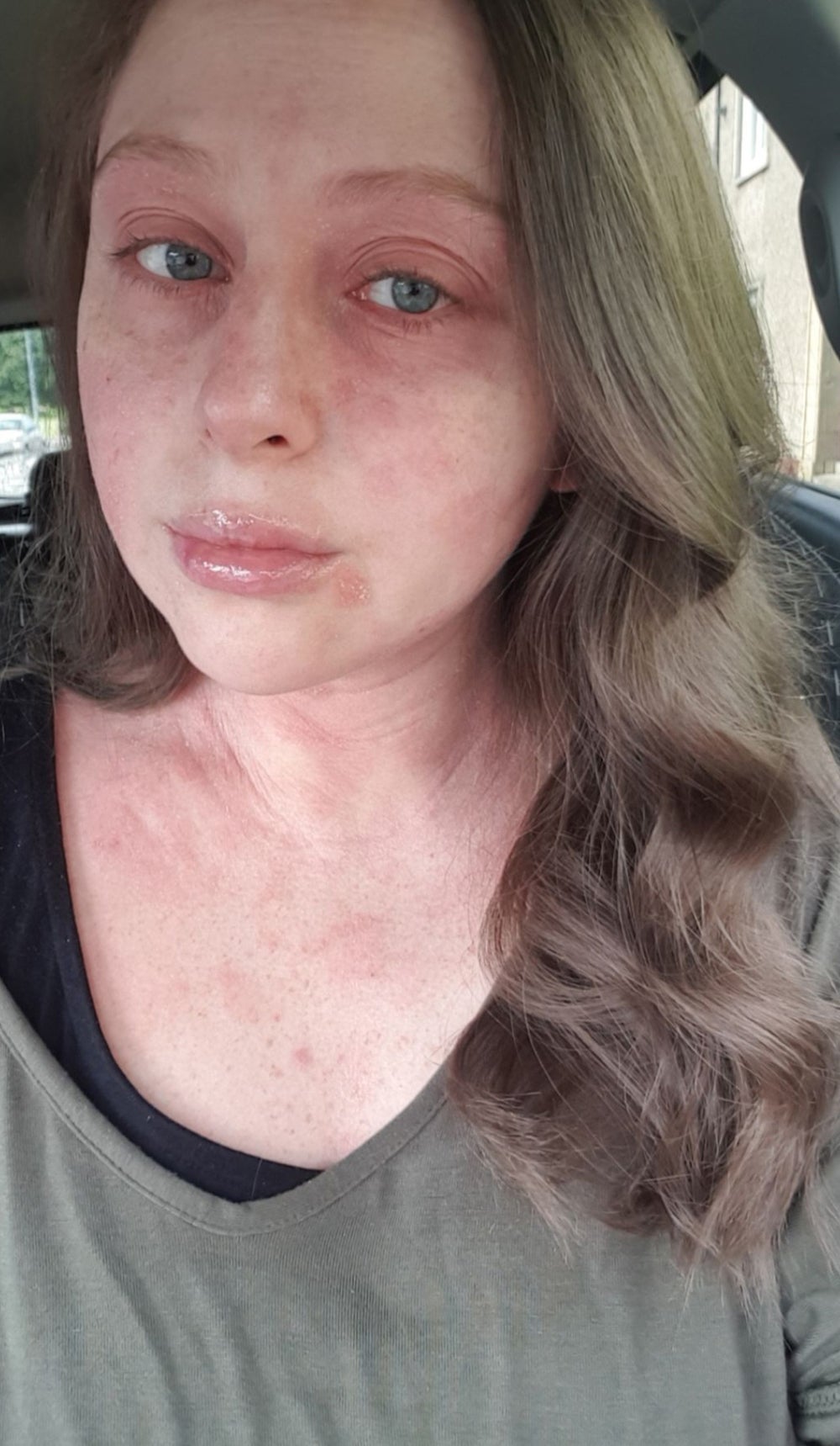 Kimberley Reardon, de 30 años, batalló enormemente con su piel en 2020