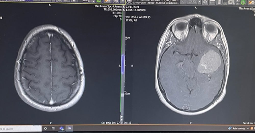Las radiografías cerebrales de Anna Kane después de la operación (izquierda) y antes de la misma (derecha)