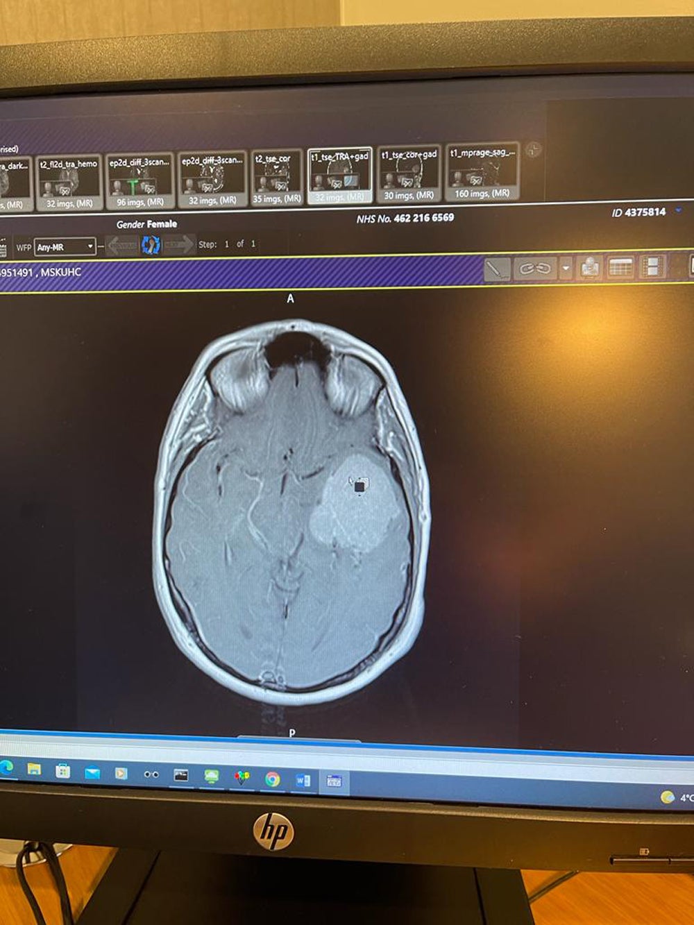 El tumor cerebral de Anna Kane medía 5,6 centímetros