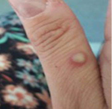 Especialistas advierten que respuesta de Biden a viruela del mono es similar al inicio de la pandemia