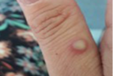 Especialistas advierten que respuesta de Biden a viruela del mono es similar al inicio de la pandemia