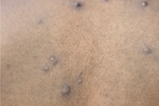 Síntomas, causas y prevención: Esto es lo que debes saber sobre la nueva epidemia de viruela del mono