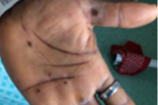 Viruela del mono es parecida al herpes y todos pueden contagiarse, asegura experta mexicana