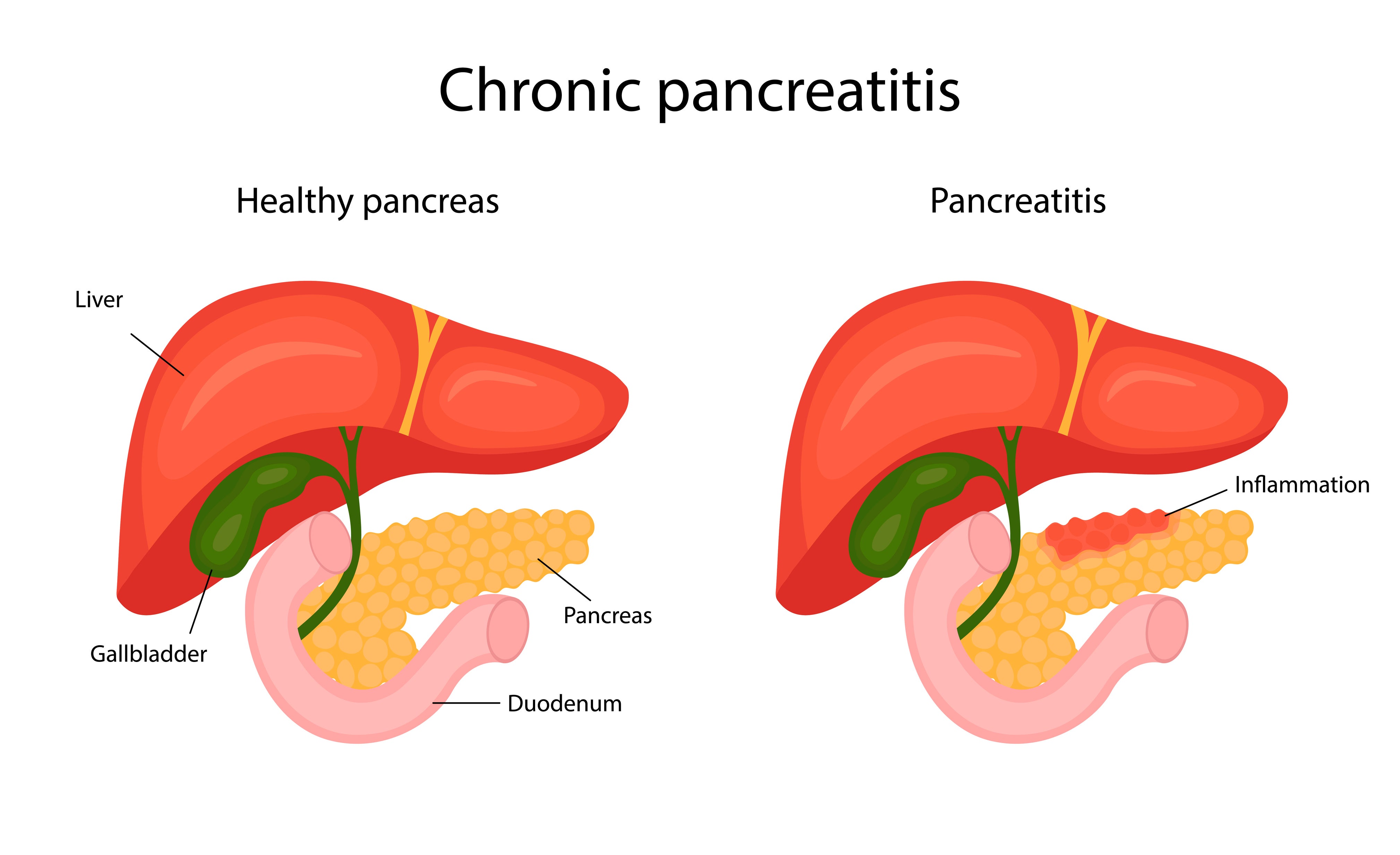 La diferencia entre un páncreas sano y un páncreas inflamado