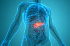 Los principales síntomas de cáncer de páncreas que pueden pasar desapercibidos