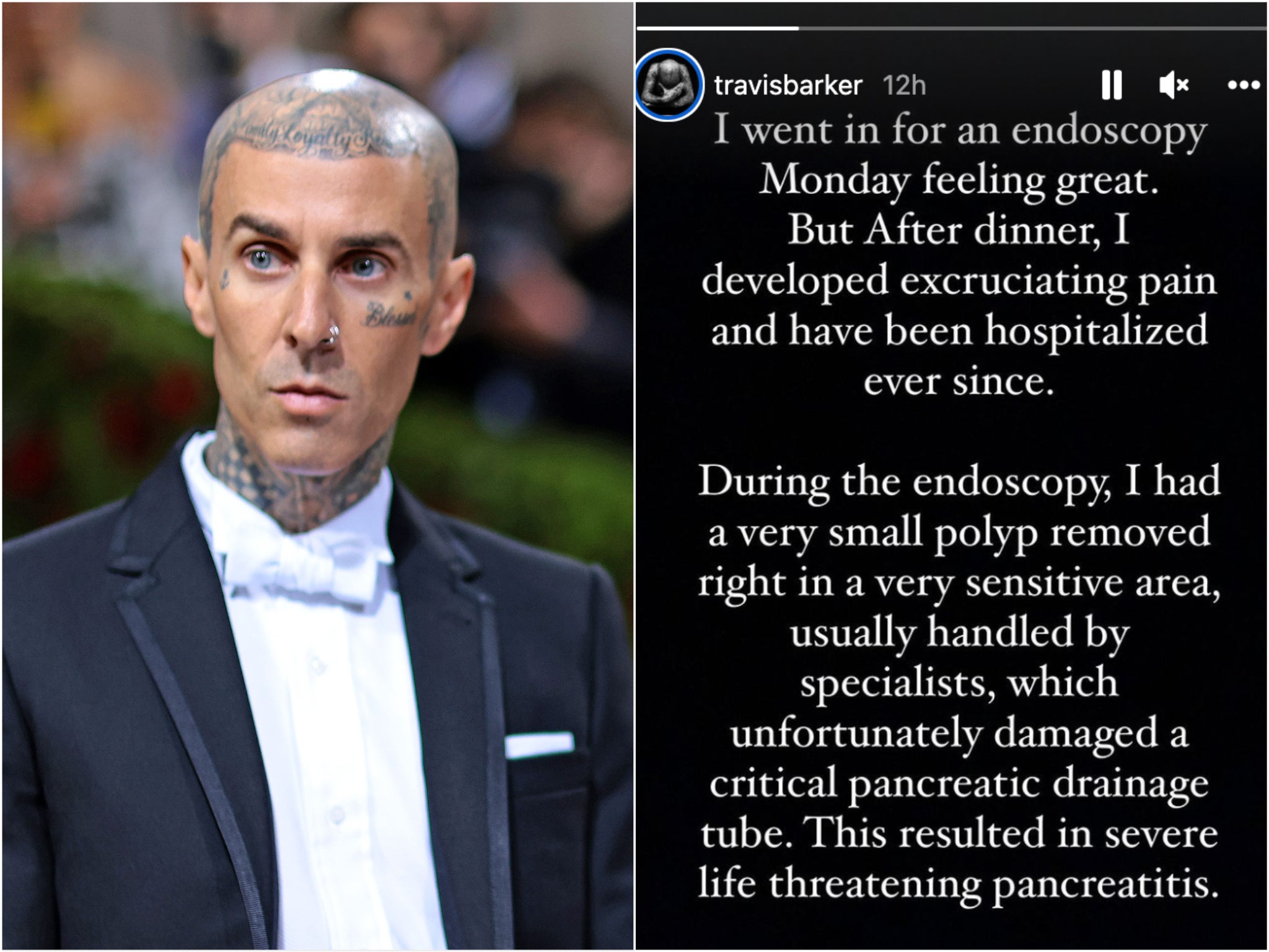 Diagnostican a Travis Barker “pancreatitis potencialmente mortal” y comparte su estado de salud