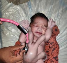 Bebé con cuatro brazos y cuatro piernas es aclamado como “reencarnación de Dios” 
