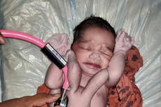 Bebé con cuatro brazos y cuatro piernas es aclamado como “reencarnación de Dios”