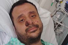 Preocupan contagios por viruela del mono en México; se contabilizan 2.654 casos positivos