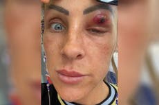 Mujer sintió un chasquido cuando “parásito” salió de su párpado “como si fuera una película de terror”