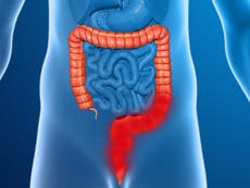 Cáncer de colon: Estudio revela los nuevos cuatro síntomas de la enfermedad