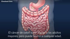 Señales de advertencia de cáncer de colon que no puedes ignorar