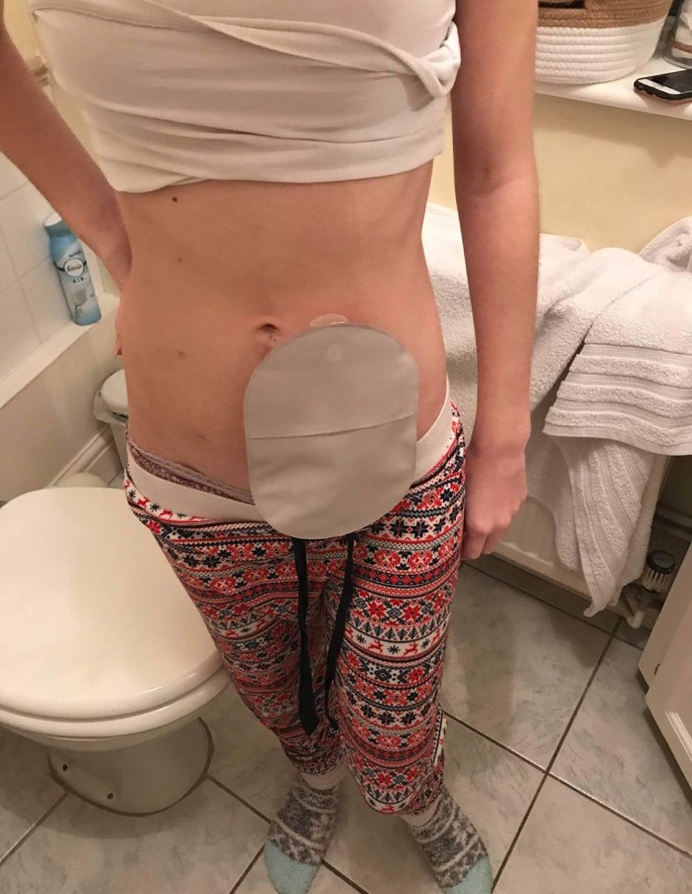 Sophie Anderson, de 24 años, con su primer bolsa de colostomía