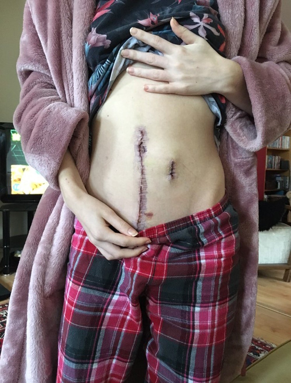 La cicatriz de Sophie tras su primera grab cirugía