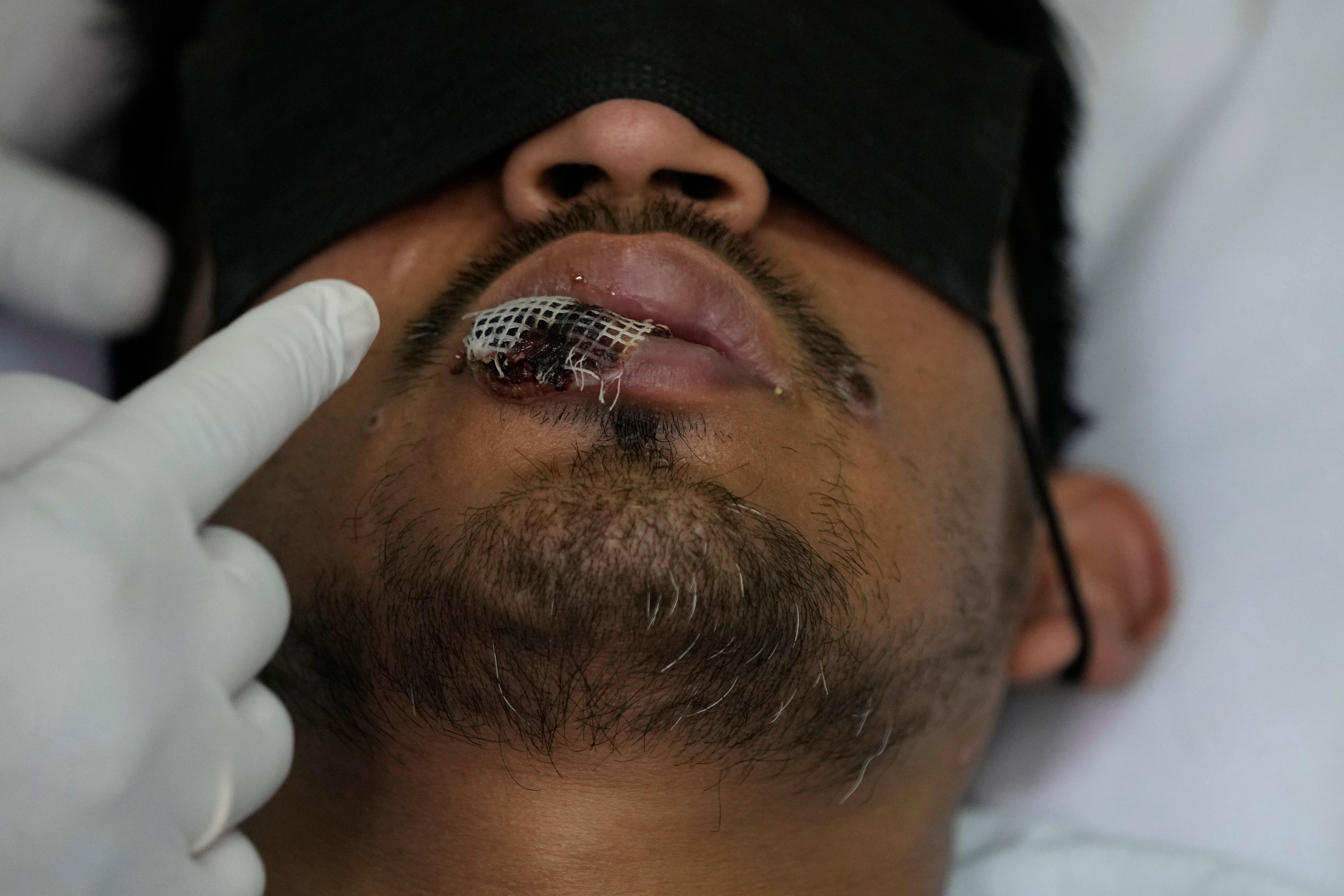 PERÚ-VIRUELA SÍMICA