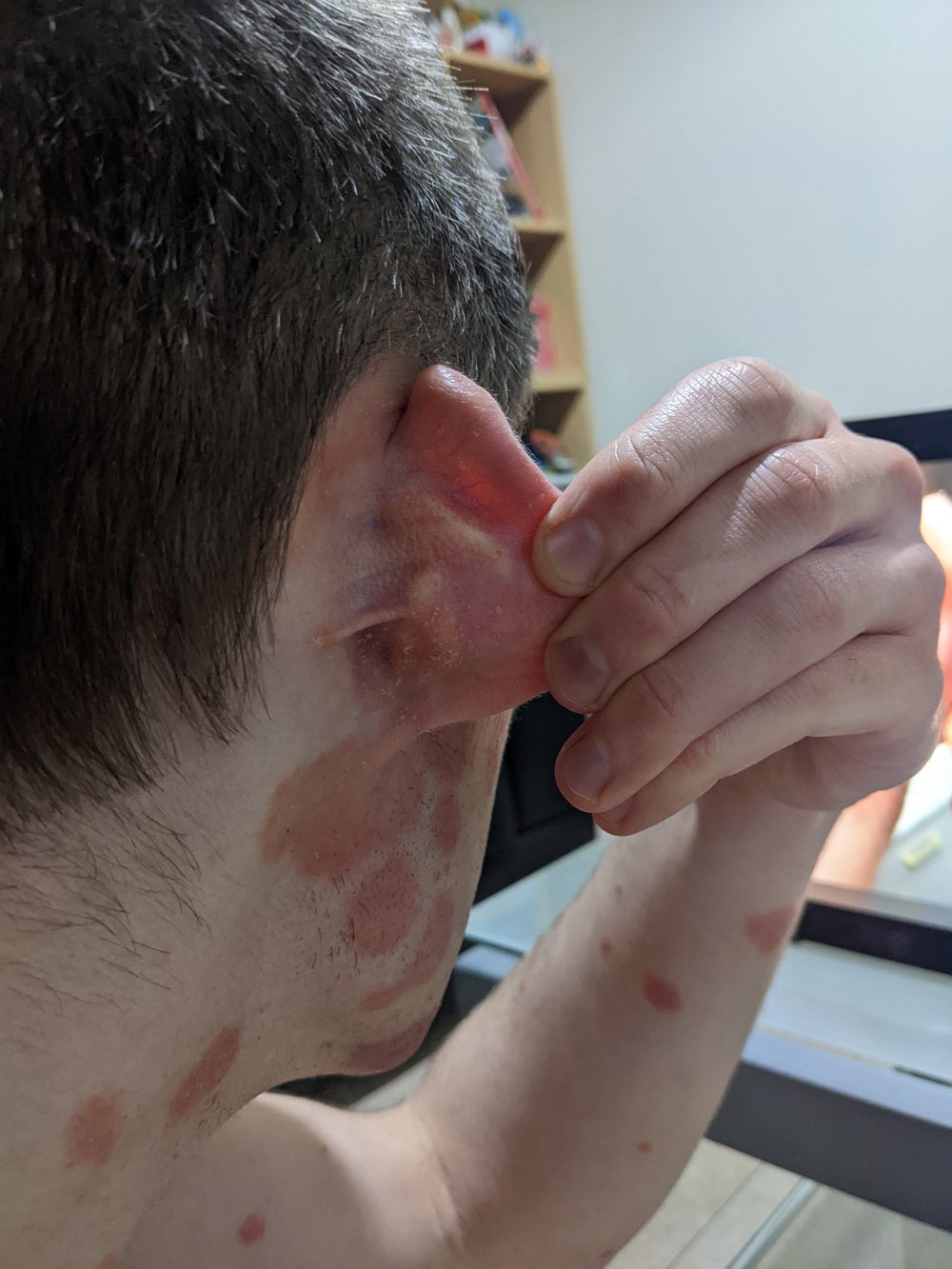 Scot Cunningham, de 27 años, con psoriasis alrededor de la oreja (Collect/PA Real Life)