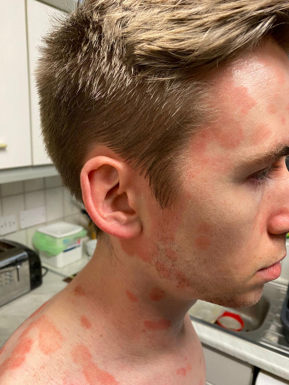 Scot Cunningham, de 27 años, perdió toda la confianza en sí mismo cuando la psoriasis se extendió a su cara (Collect/PA Real Life)