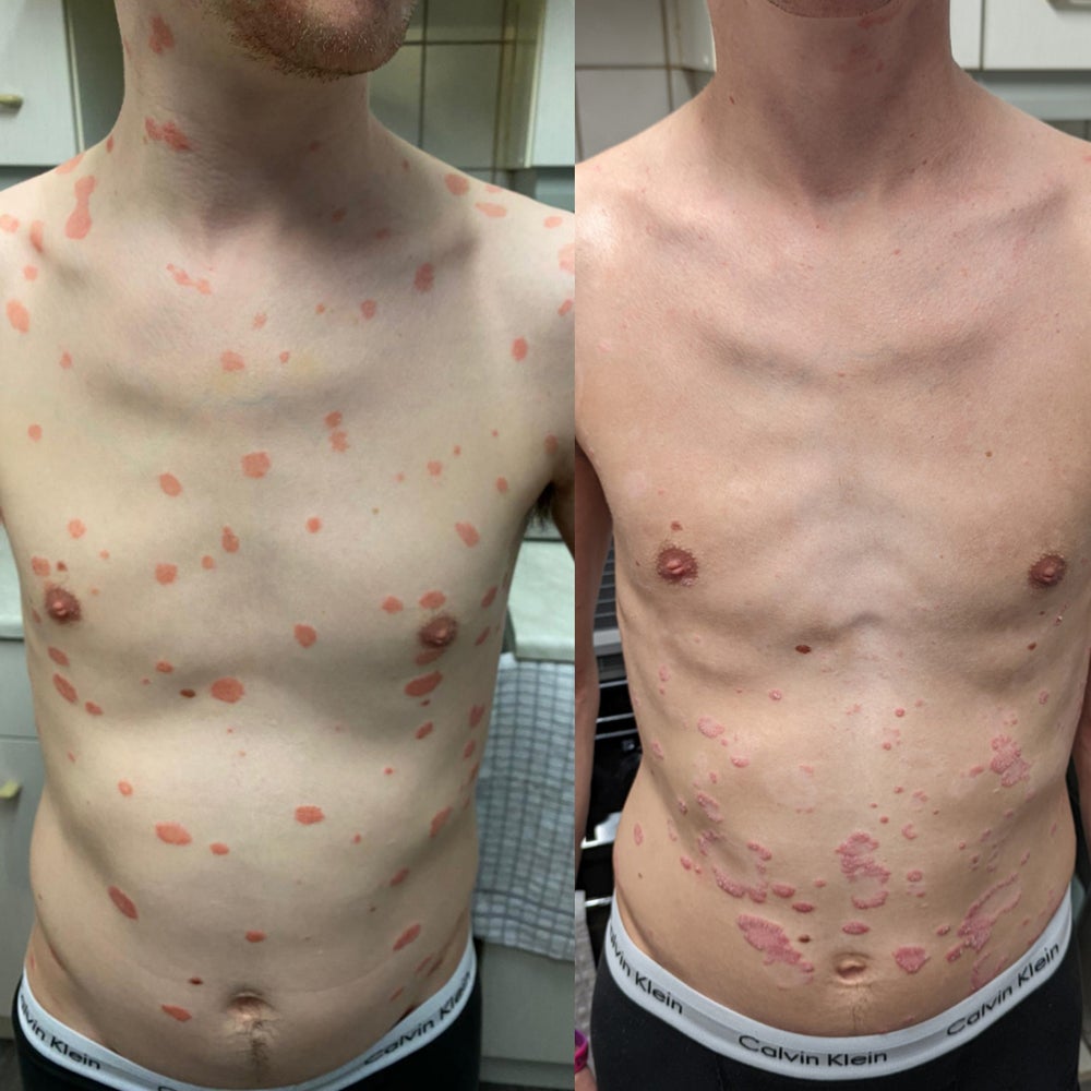 Scot Cunningham, 27 años, antes y después de encontrar la crema y cambiar su dieta (Collect/PA Real Life)