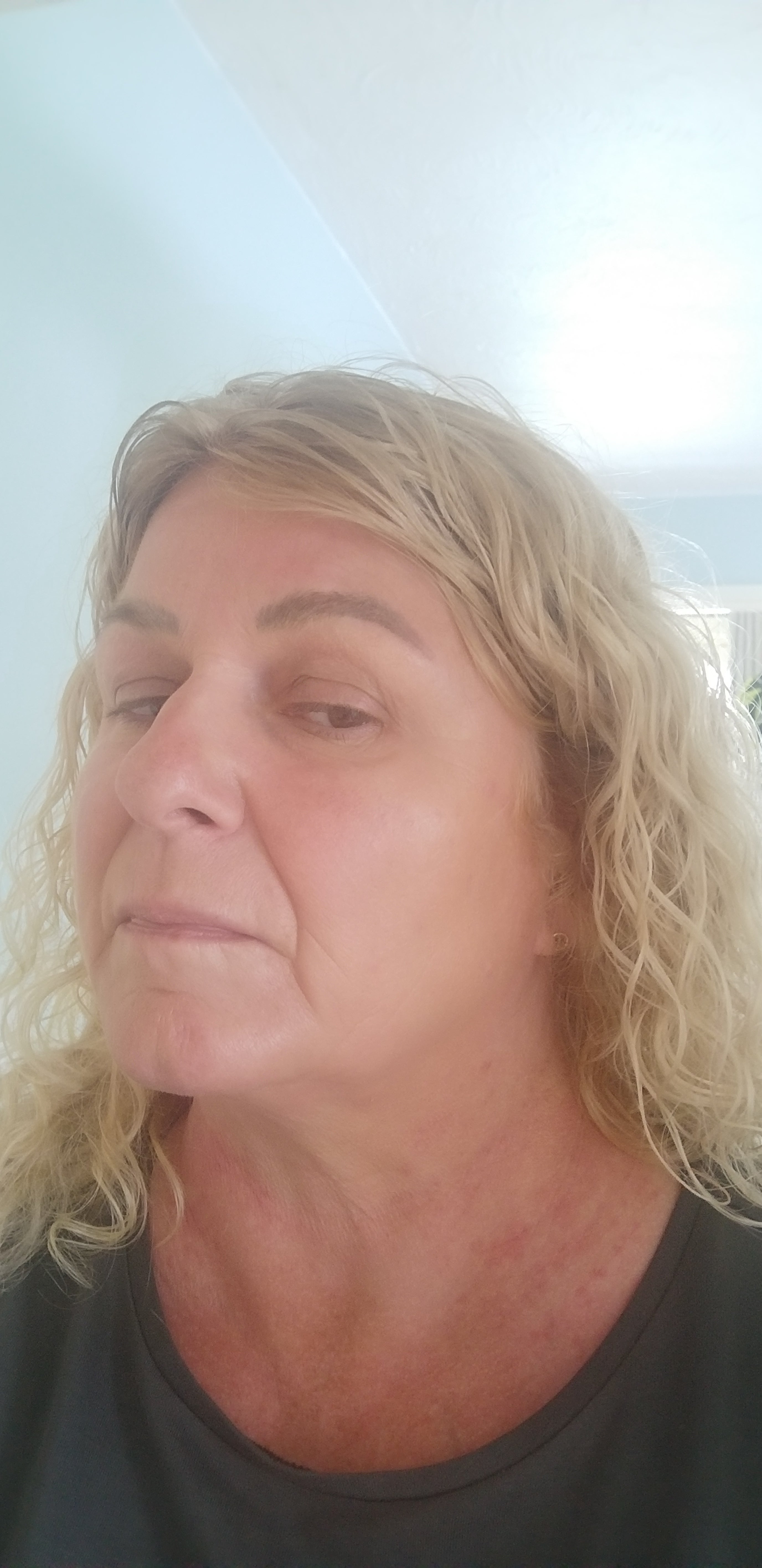 El eczema de Lisa desapareció tras dos semanas de usar el gel de ojos