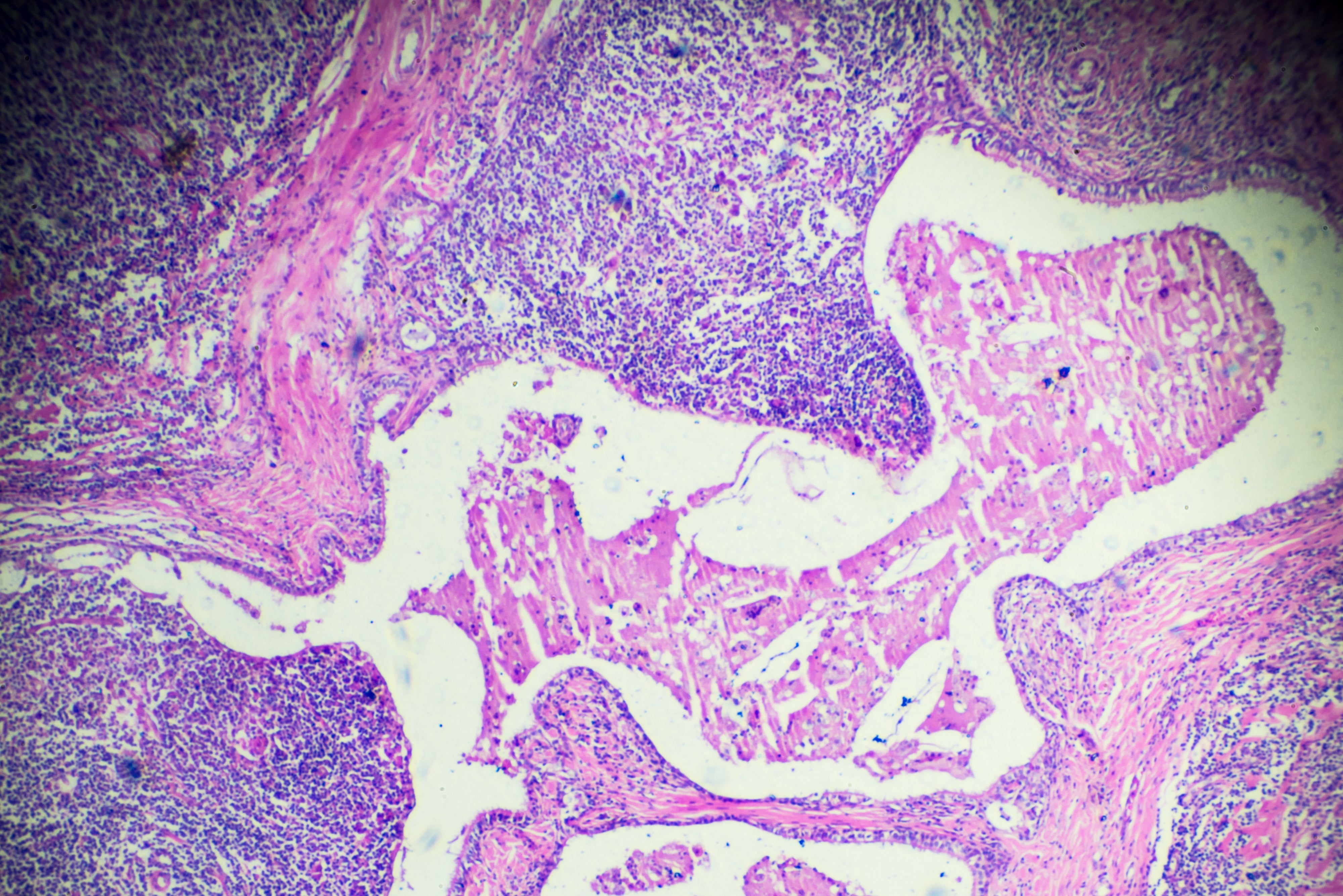 Células de linfoma de Hodgkins bajo el microscopio