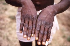 Expertos piden dar prioridad a la fiebre símica en África