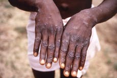 Expertos piden dar prioridad a la fiebre símica en África