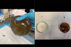 Mujer comparte foto de implante mamario “mohoso” que le provocó una enfermedad autoinmune