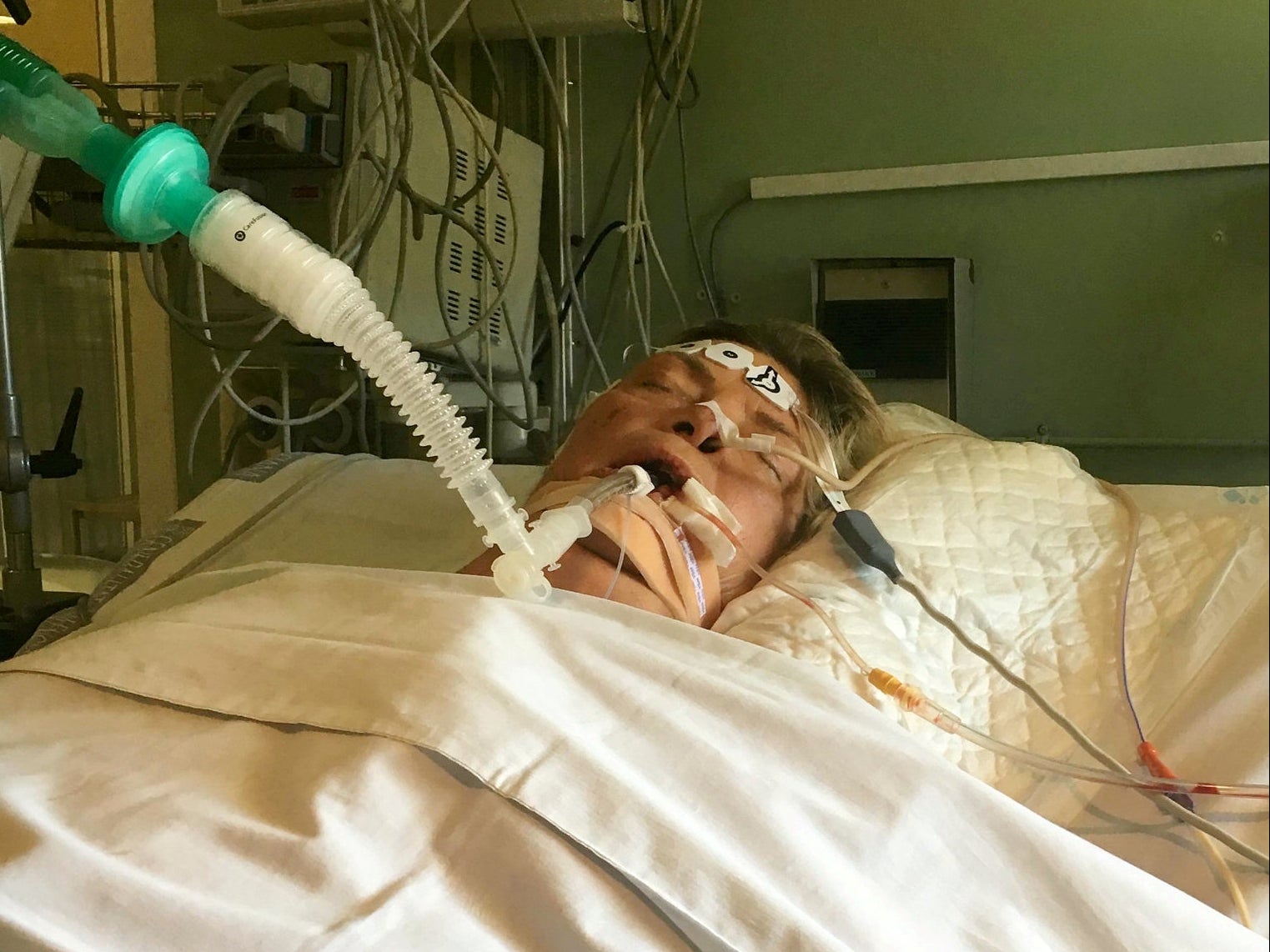 Amputan extremidades a mujer después de desarrollar sepsis por ITU común