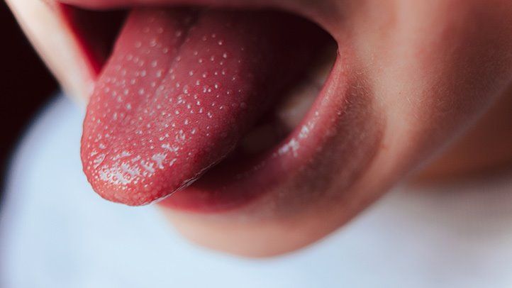 Un síntoma inicial común de la enfermedad es una lengua roja e hinchada con manchas rojas, conocida como “lengua de fresa”