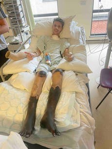 Joven futbolista internado con síntomas de gripe termina con ambas piernas amputadas 