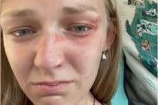 Nueva foto evidencia heridas de Gabby Petito tras incidente de violencia doméstica con Brian Laundrie