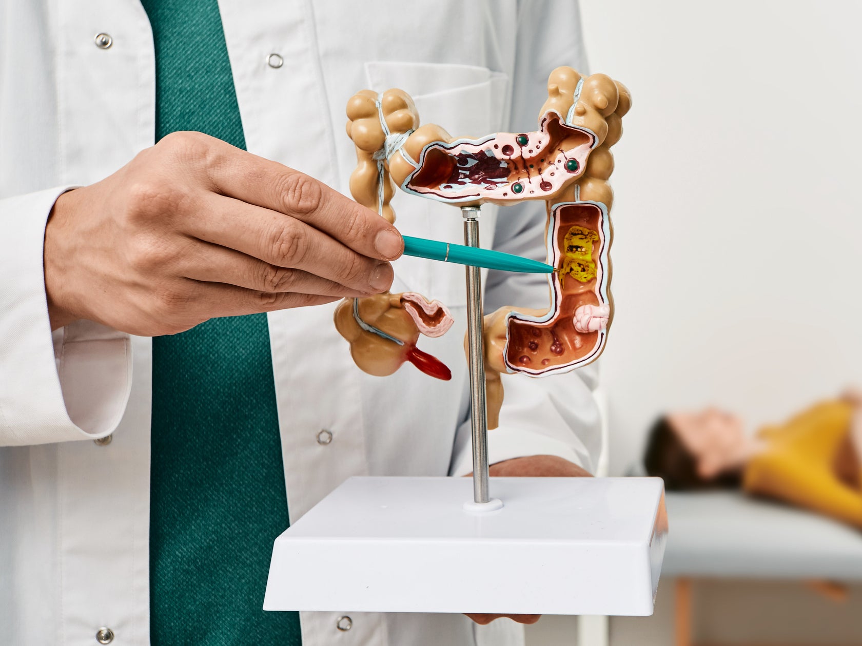 Estos son las señales de advertencia del cáncer de colon que no debes ignorar