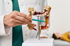 Estos son las señales de advertencia del cáncer de colon que no debes ignorar