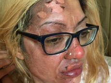 Madre advierte en contra de peligroso “truco” de cocina en TikTok que le quemó la cara