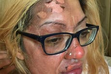 Madre advierte en contra de peligroso “truco” de cocina en TikTok que le quemó la cara