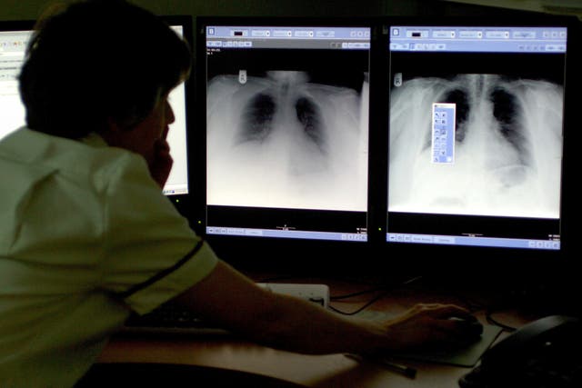 <p>Según la investigación, cerca de 200.000 de los casos de adenocarcinoma diagnosticados en 2022 en el mundo (es decir, el 15 %) se debieron a la contaminación atmosférica</p>