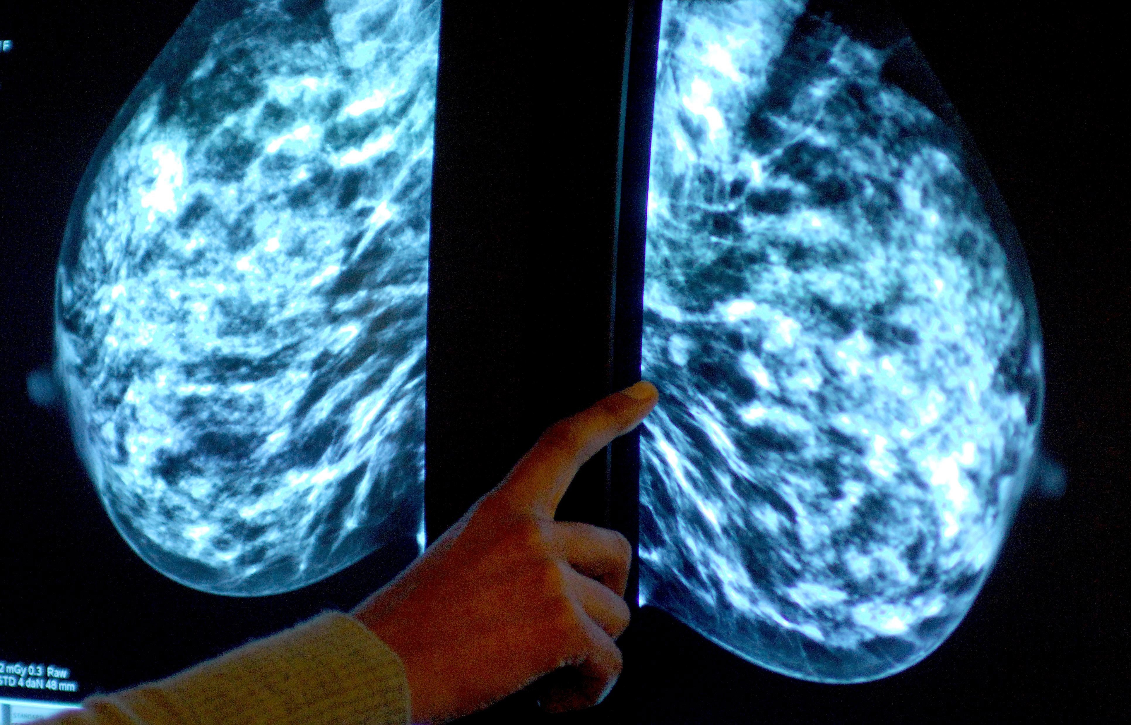 Una mamografía muestra el pecho de una mujer en el hospital Derby City para detectar cáncer de mama