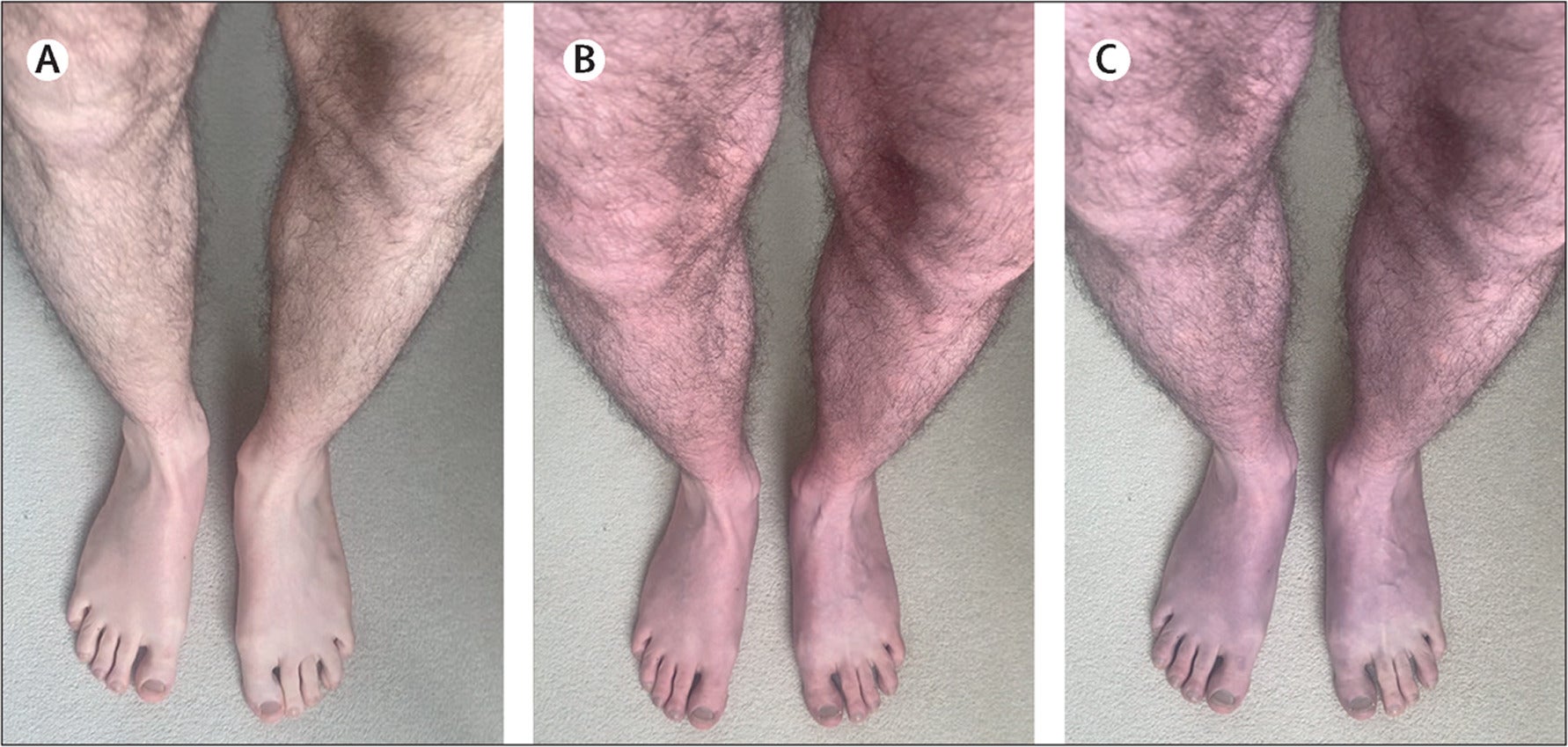 El paciente, de 33 años, presentó una “rápida decoloración púrpura” en las piernas
