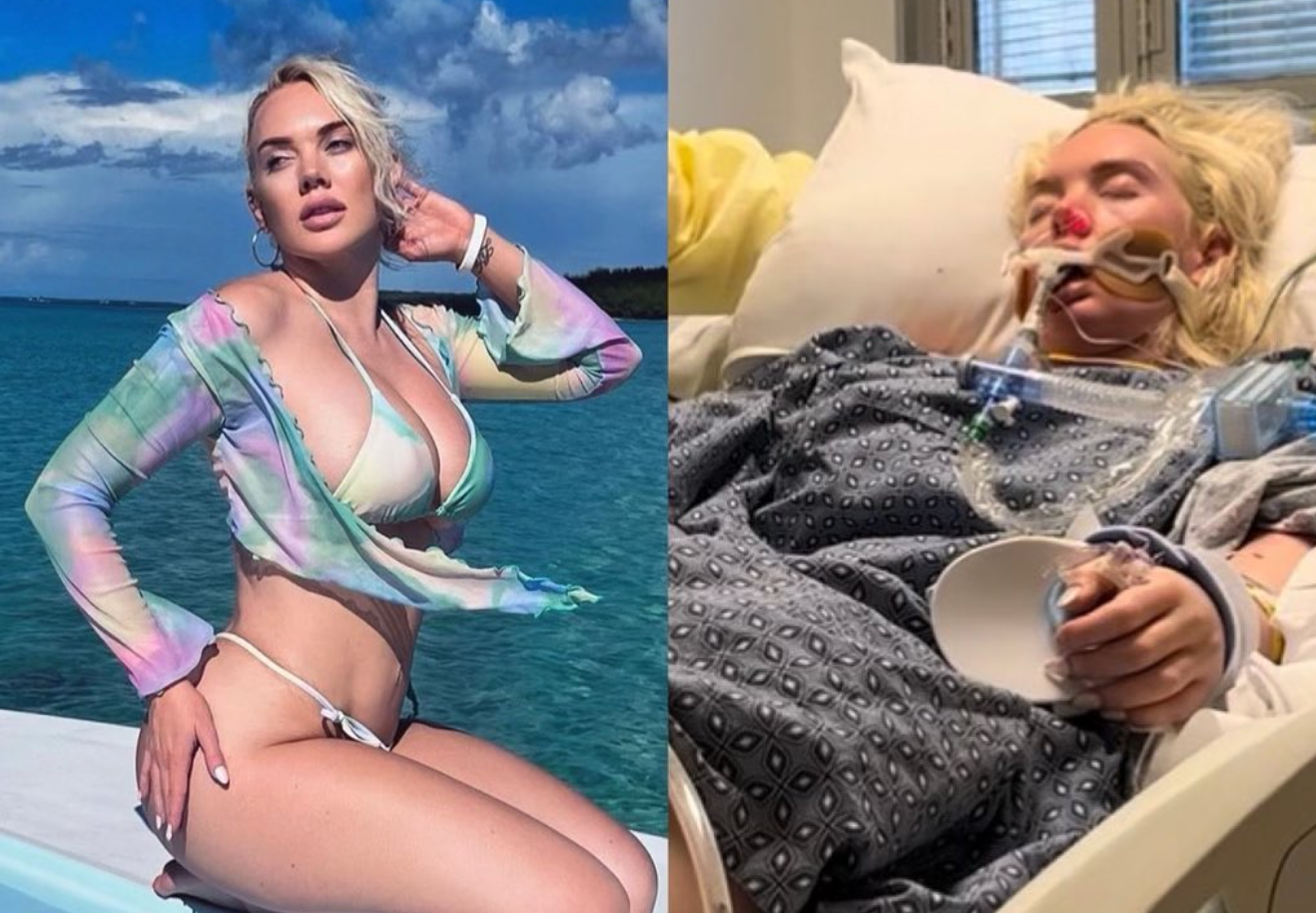 Modelo pierde una pierna tras infectarse con la bacteria “comecarne”. Pero, ¿qué es y cómo evitarla?