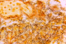 Informe: EEUU registra su mayor cantidad de casos de sífilis desde 1950; otras ETS están a la baja