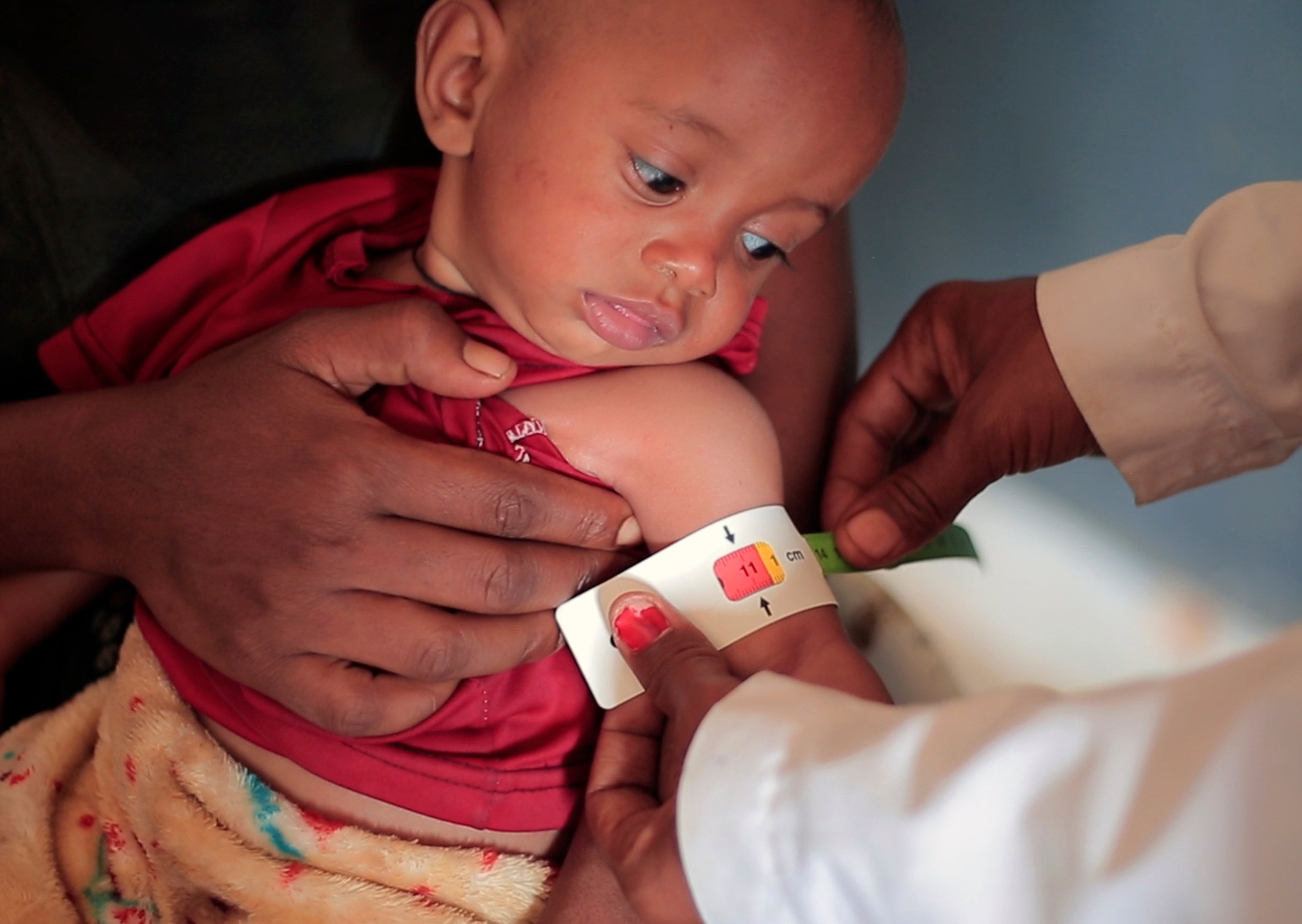 Una enfermera mide la circunferencia del brazo (perímetro braquial) de Temesgen Muluhaw, un niño de ocho meses que sufre desnutrición, en Mai Mekden, al norte de Etiopía