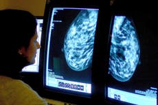 Evalúan el uso de IA en el tratamiento contra el cáncer de mama