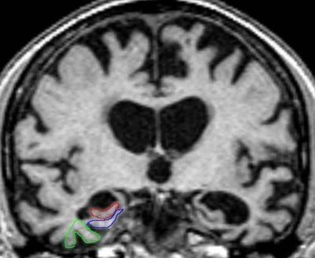 <p>Una resonancia magnética cerebral muestra una atrofia severa indicativa de patología de Alzheimer en las tres áreas, excepto en la corteza perirrinal derecha, que presenta una atrofia moderada</p>