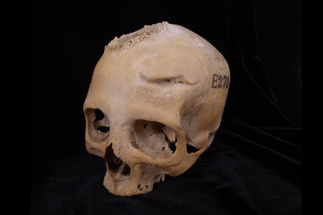 <p>Los investigadores encontraron marcas de corte en un cráneo alrededor de una gran lesión que se cree que fue causada por un tumor canceroso</p>