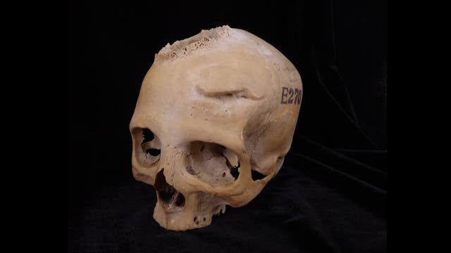 <p>Los investigadores encontraron marcas de corte en un cráneo alrededor de una gran lesión que se cree que fue causada por un tumor canceroso</p>
