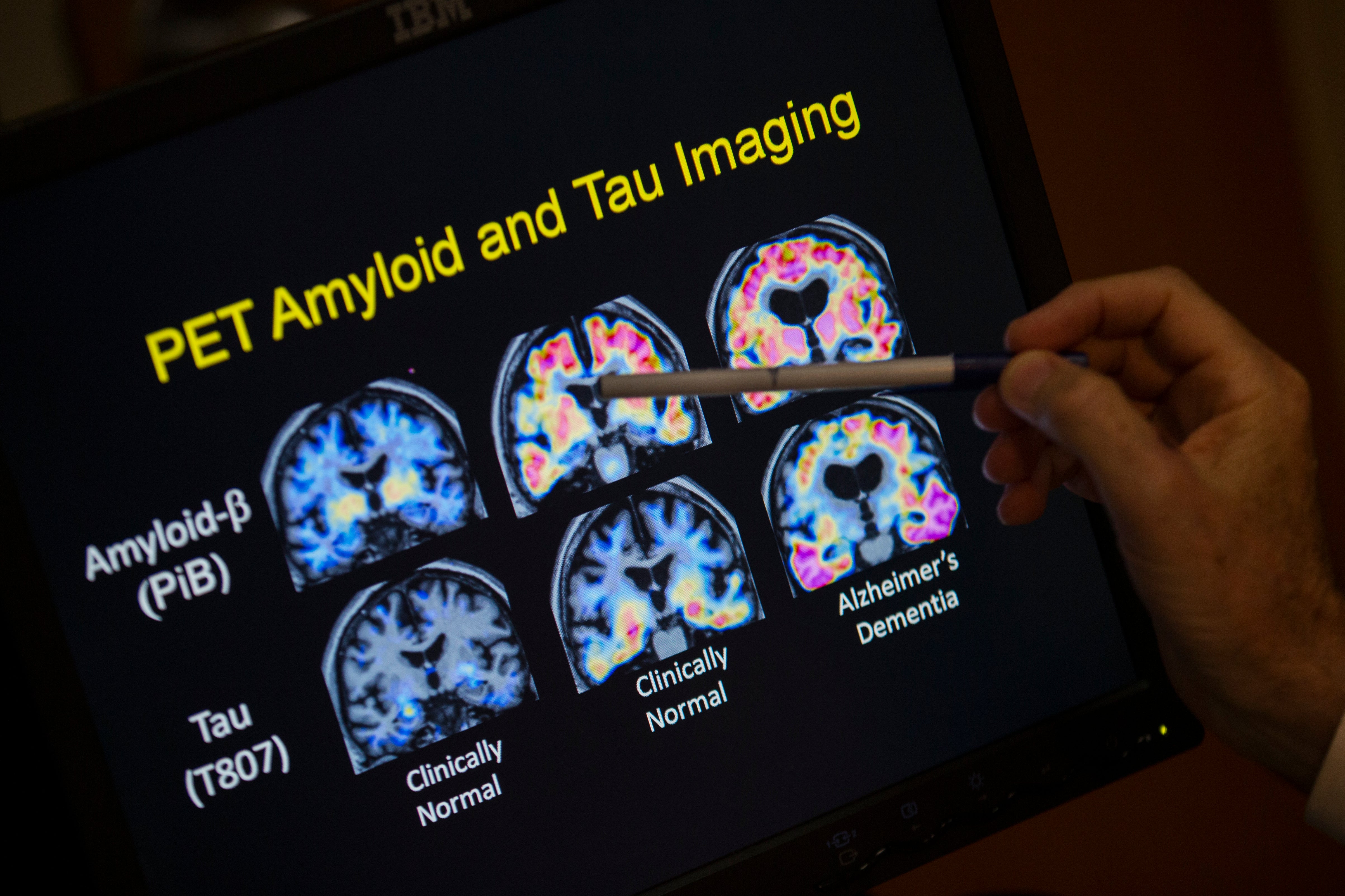 ALZHEIMER-ANALISIS DE SANGRE