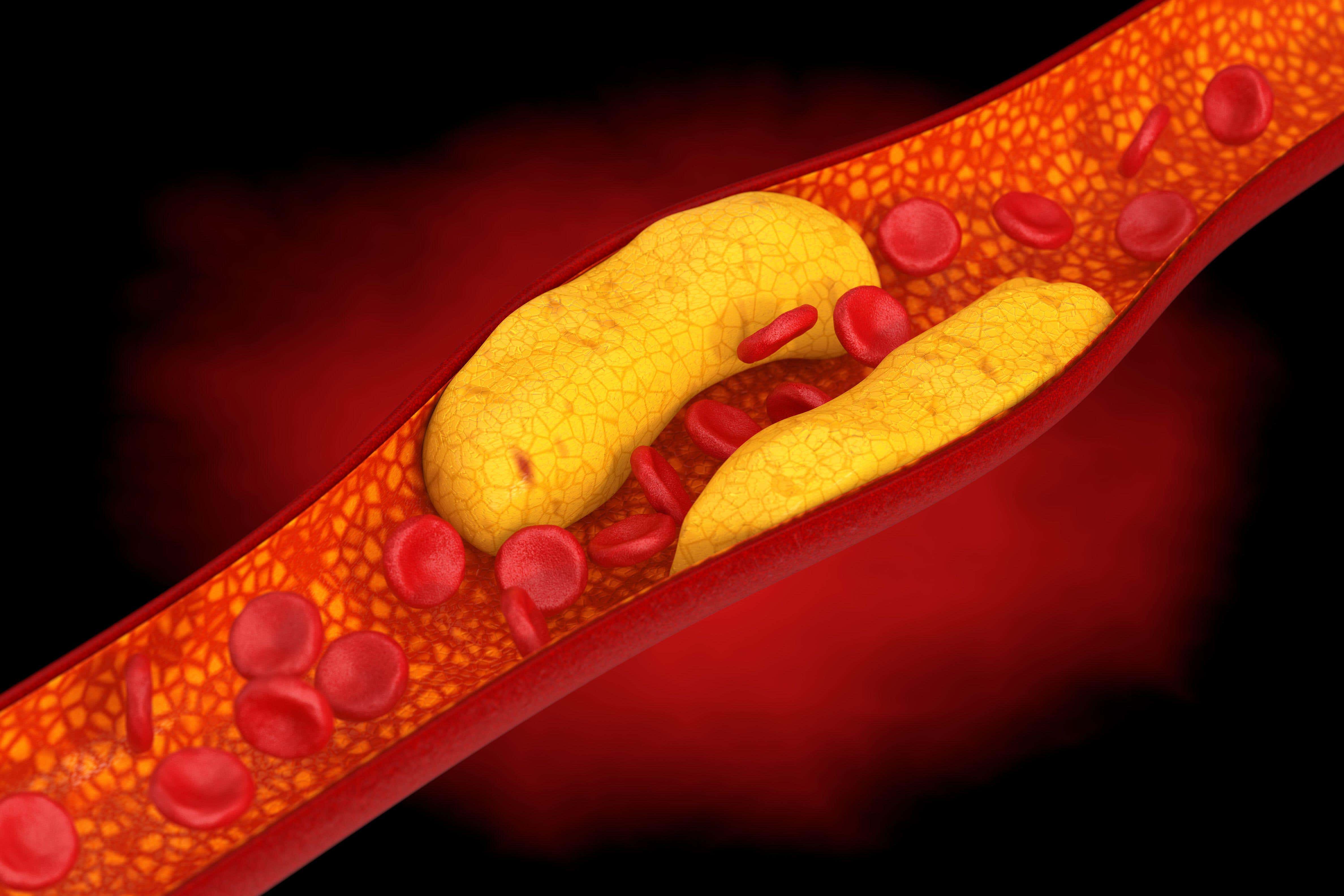 Arteria obstruida por el colesterol