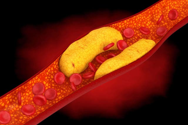 <p>Arteria obstruida por el colesterol </p>