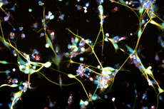Descubren que una terapia celular podría ayudar a combatir tumores cerebrales